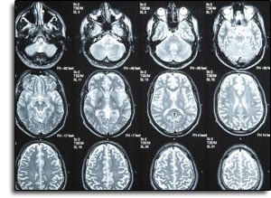 X-Ray of Brain